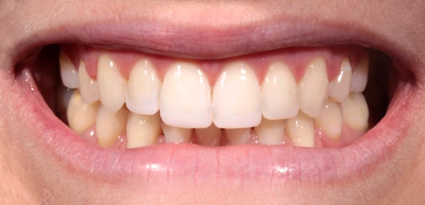 invisalign-and-edge-bonding-after