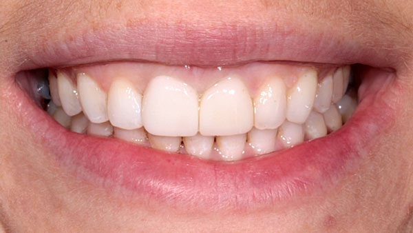 invisalign-and-veneers-2-after