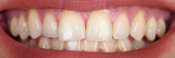 teeth-whitening-2-before