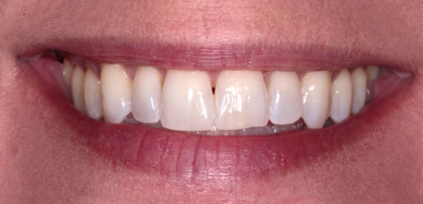 teeth-whitening-after