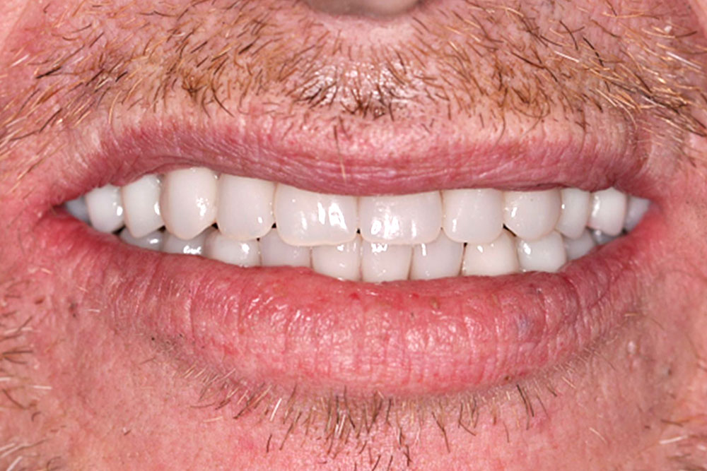 all-on-4-1-after